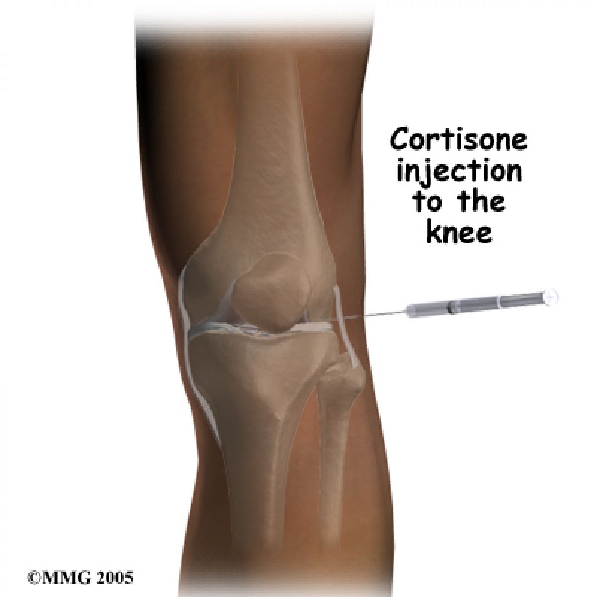 Is steroid injection bad for your knee?