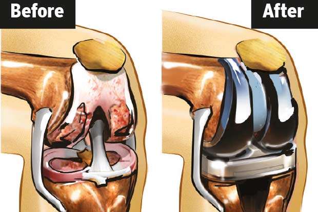Joint preservation an effective alternative to knee ...