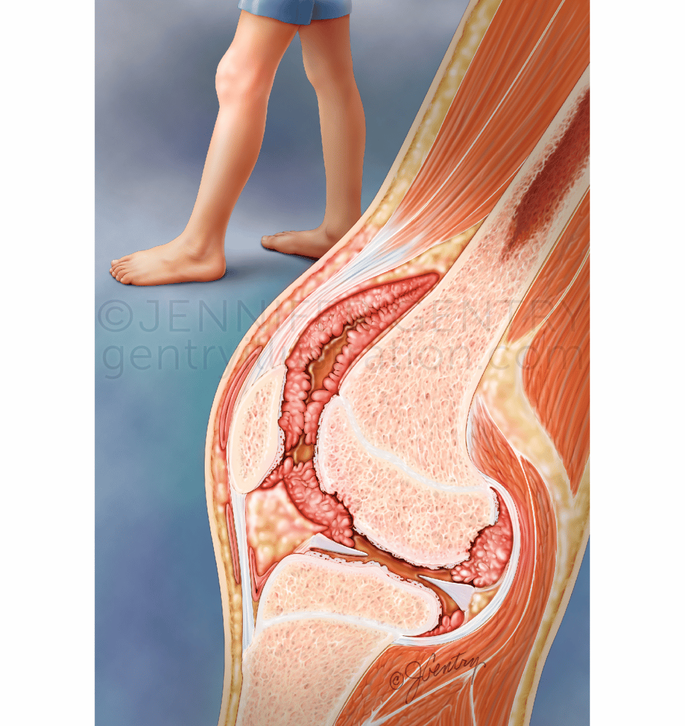 Juvenile Idiopathic (Rheumatoid) Arthritis (JIA) Affected Knee Joint ...
