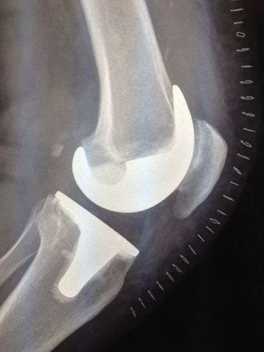 Knee â Total knee replacement (TKR)