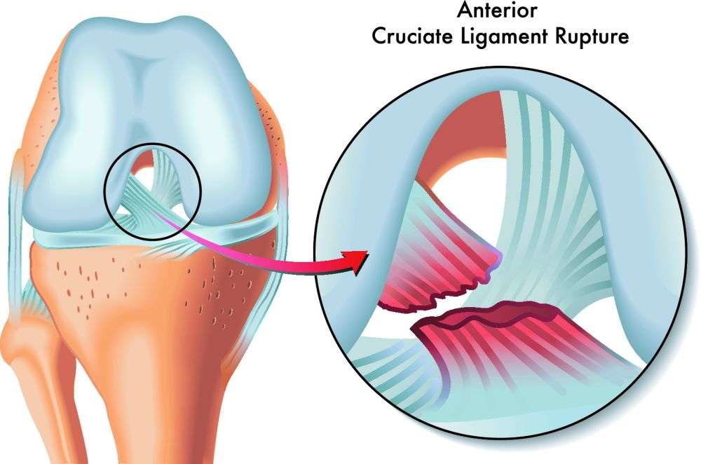 Knee ACL Tears: Symptoms, Causes, and Treatment â Injury Health Blog