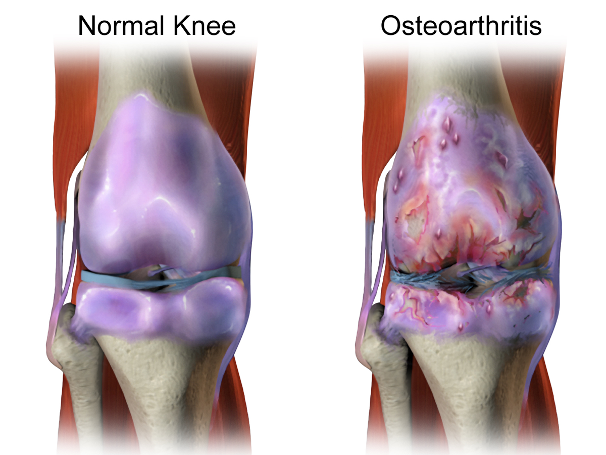 Knee arthritis has doubled since 1950, and we don
