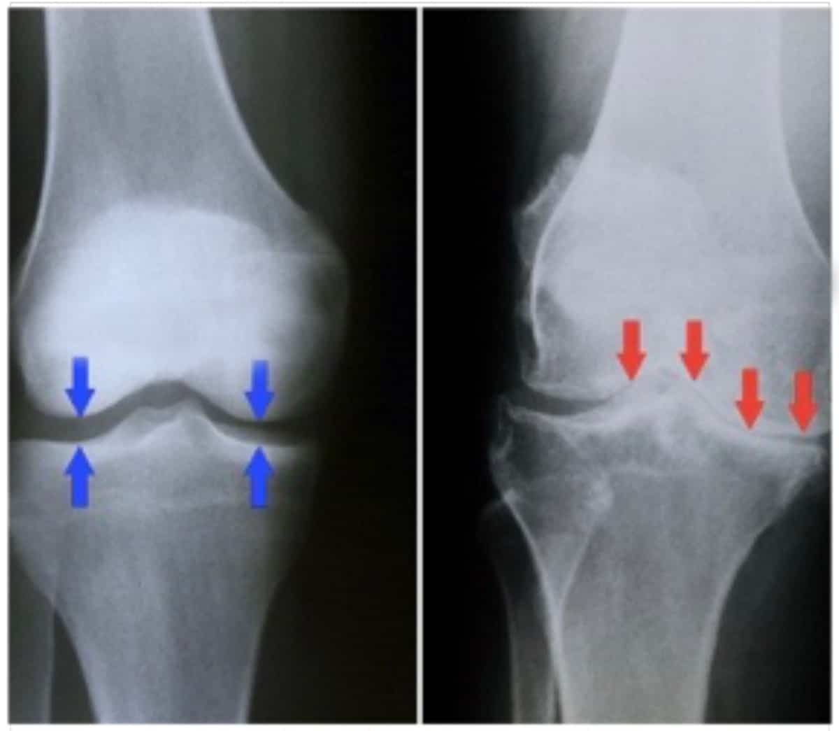 Knee Arthritis In Your 30âs Infection Rheumatoid Trigger