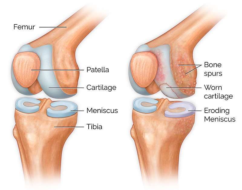Knee Arthritis, Patient Education