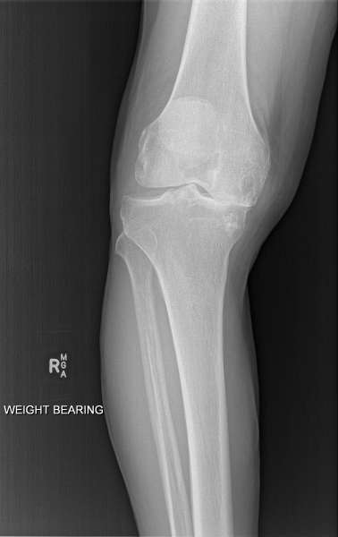 Knee Arthritis :: Sunshine Coast Knee and Hip Clinic