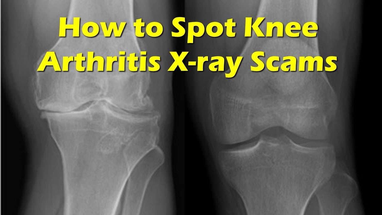 knee arthritis x