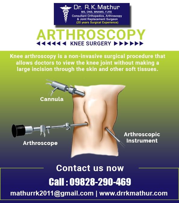 Knee arthroscopy is a surgical procedure that is used to look, diagnose ...