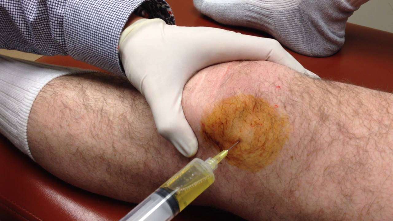 Knee Aspir Injection Single needle