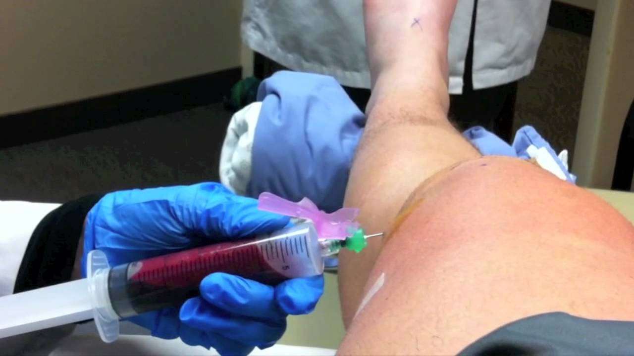 Knee aspiration (draining) after ACL surgery