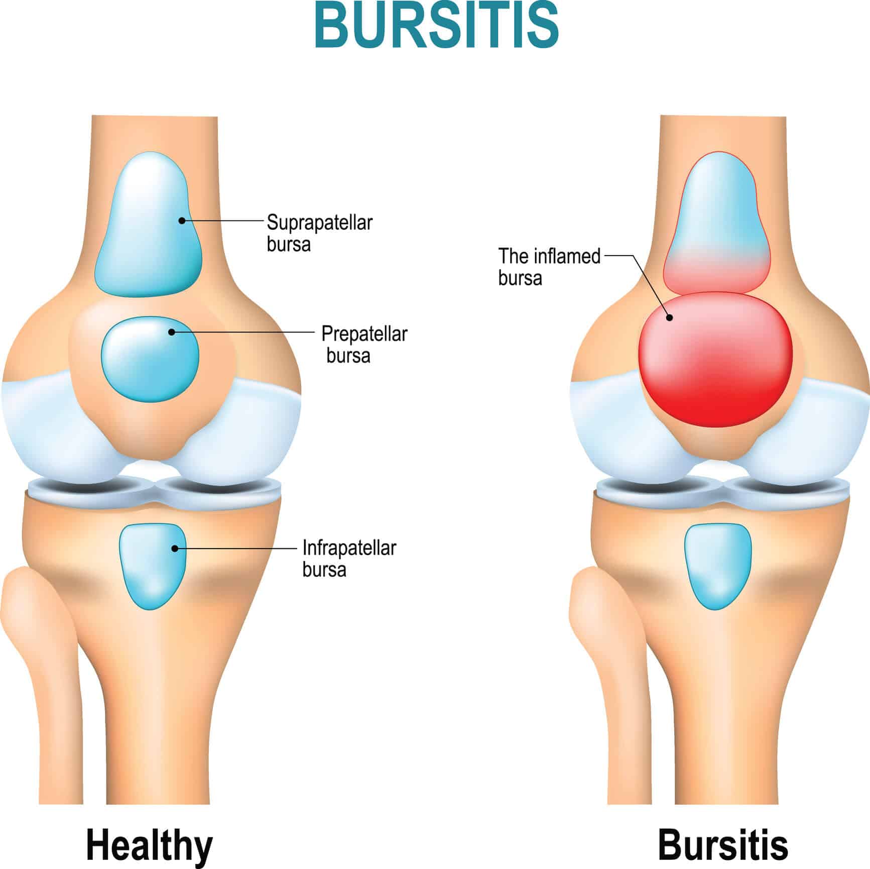 Knee Bursitis: Causes, Symptoms &  Treatment Â· Dunbar Medical