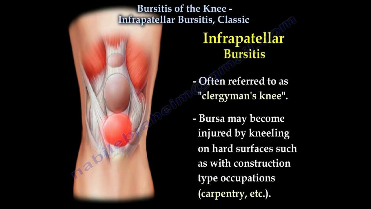 Knee Bursitis Infrapatellar Bursitis Classic