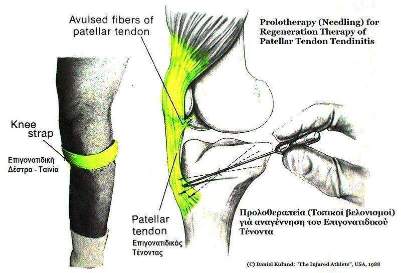 Knee Cap Pain and Types of Kneecap Injury