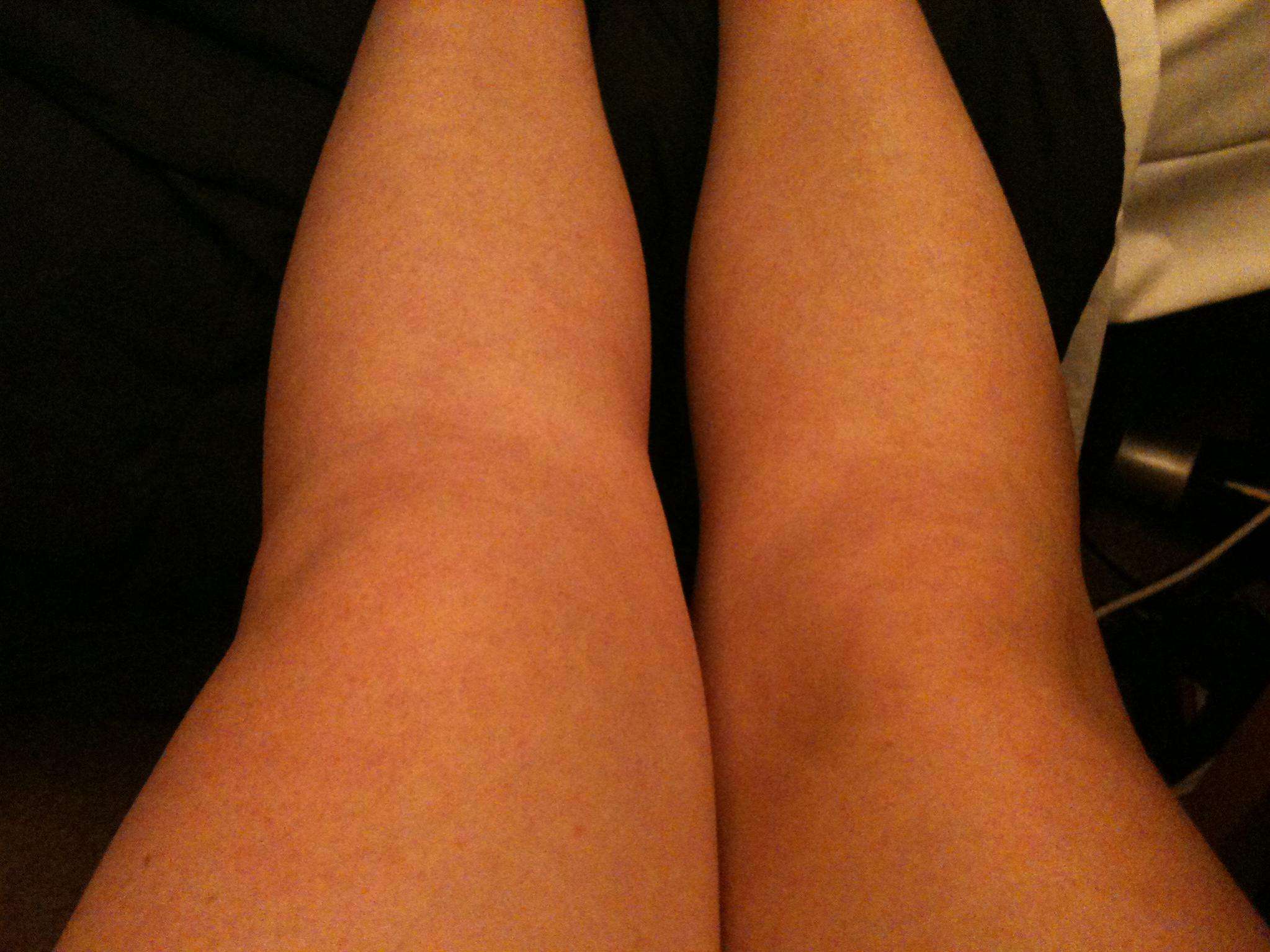 Knee effusion (swelling) help