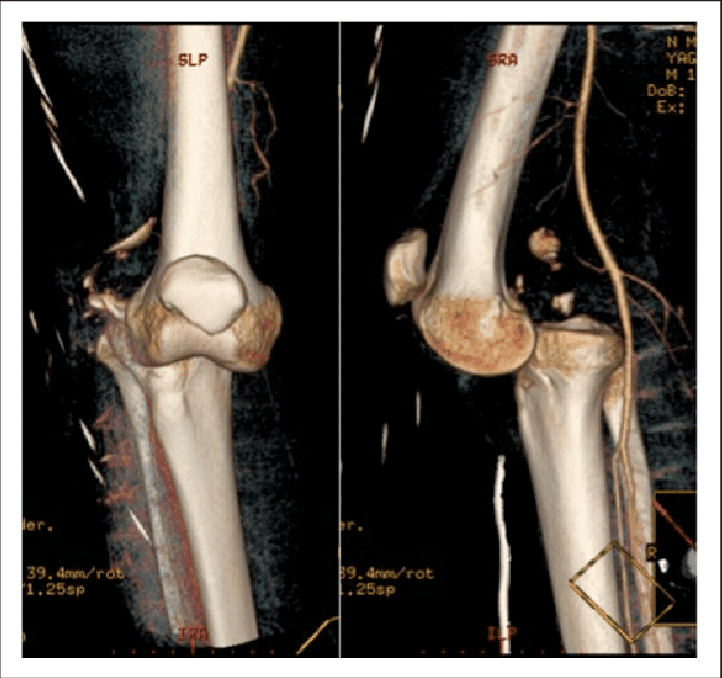 Knee Joint Dislocation