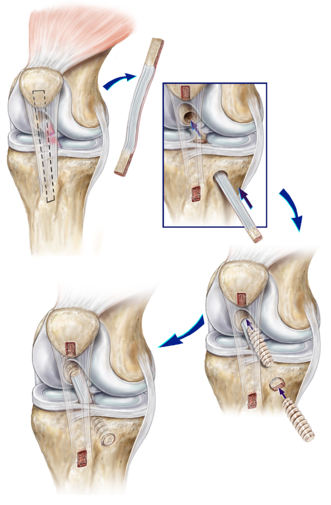 Knee Ligament Injuries: Tears of the Anterior Cruciate Ligament (ACL ...