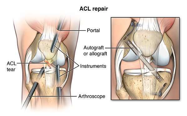 Knee Ligament Repair