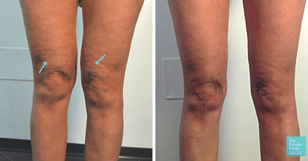 Knee Liposuction, non