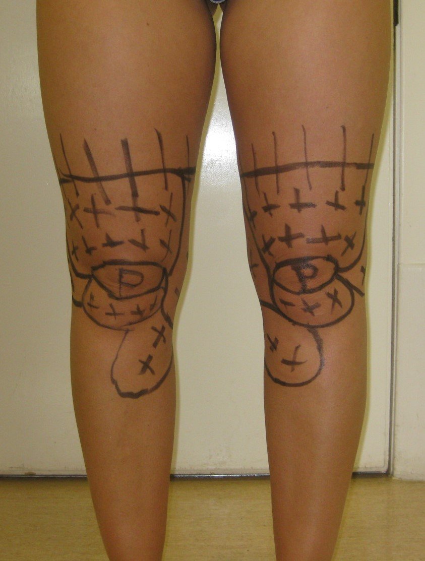 Knee liposuction : sculpting and refining
