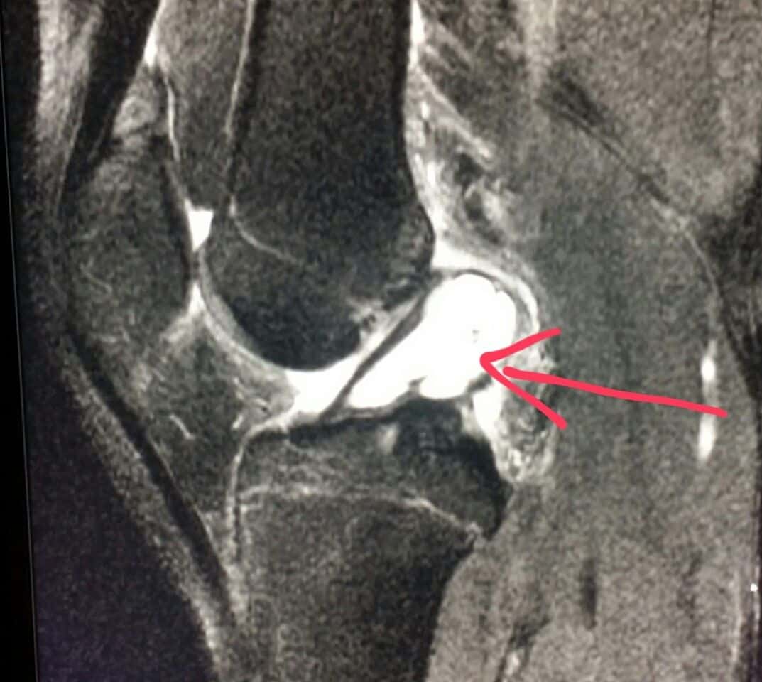 #Knee #MRI shows an #ACL #cyst (#ganglion) in a #patient with knee # ...