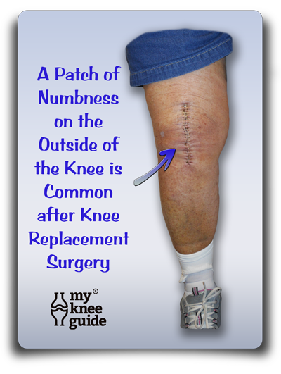 Knee Numbness: A common post