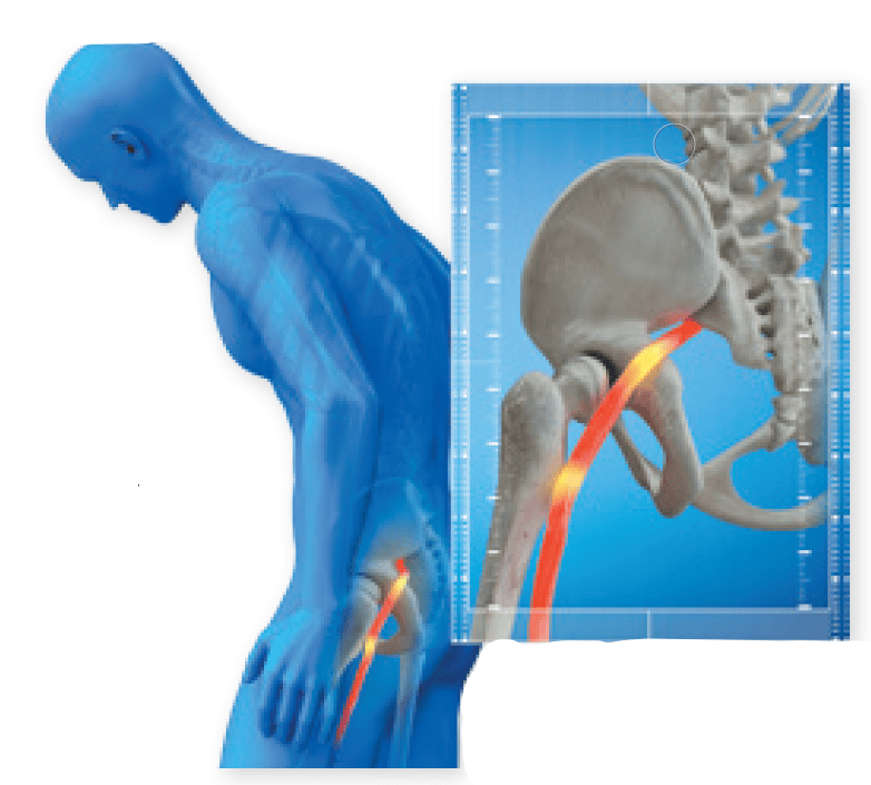 Knee or Hip Pain from Your Back