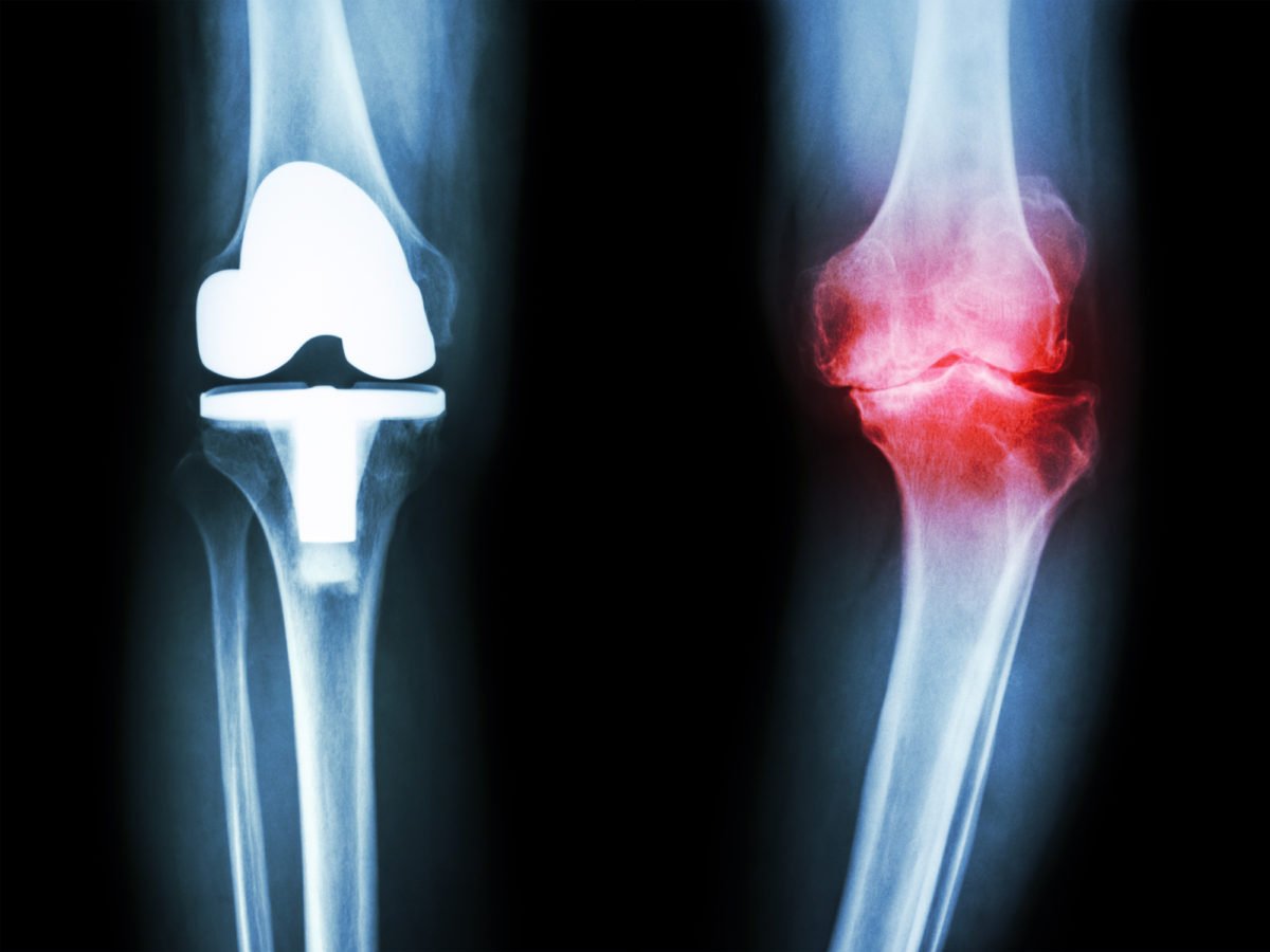 Knee Osteoarthritis 101: The Basics  Pain Management at ...