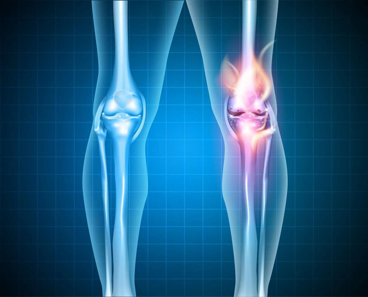 Knee Osteoarthritis 101