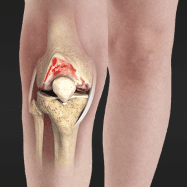 Knee osteoarthritis, a common cause of knee pain: Orthopedic Center for ...