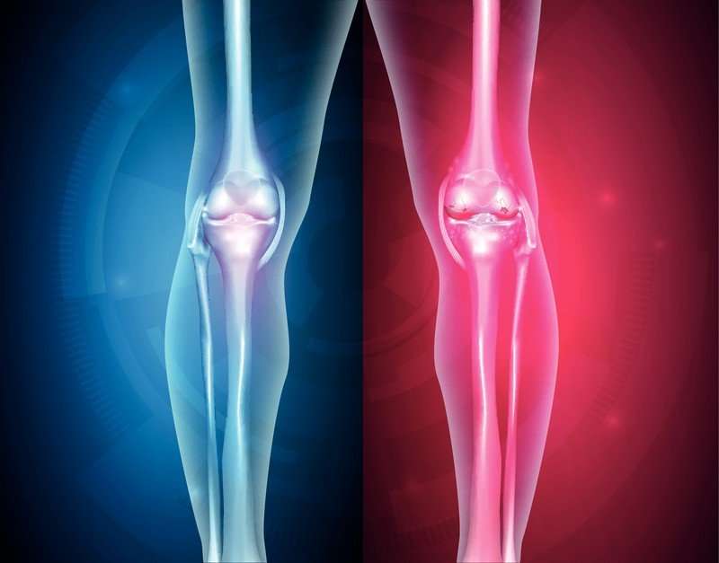 Knee Osteoarthritis and Platelet Rich Plasma Therapy ...