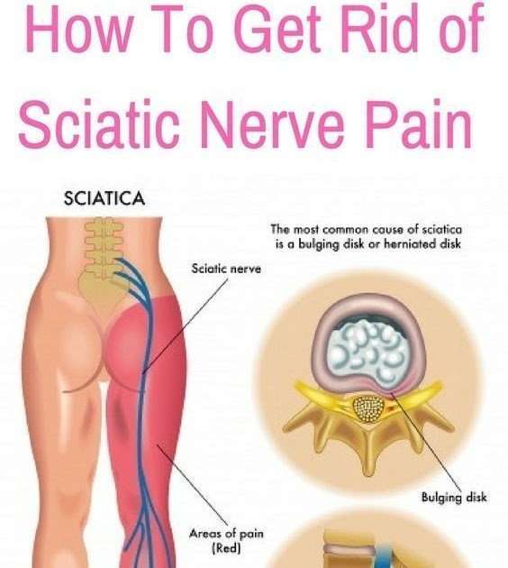 Knee pain: Back pain treatment exercises for sciatica and ...