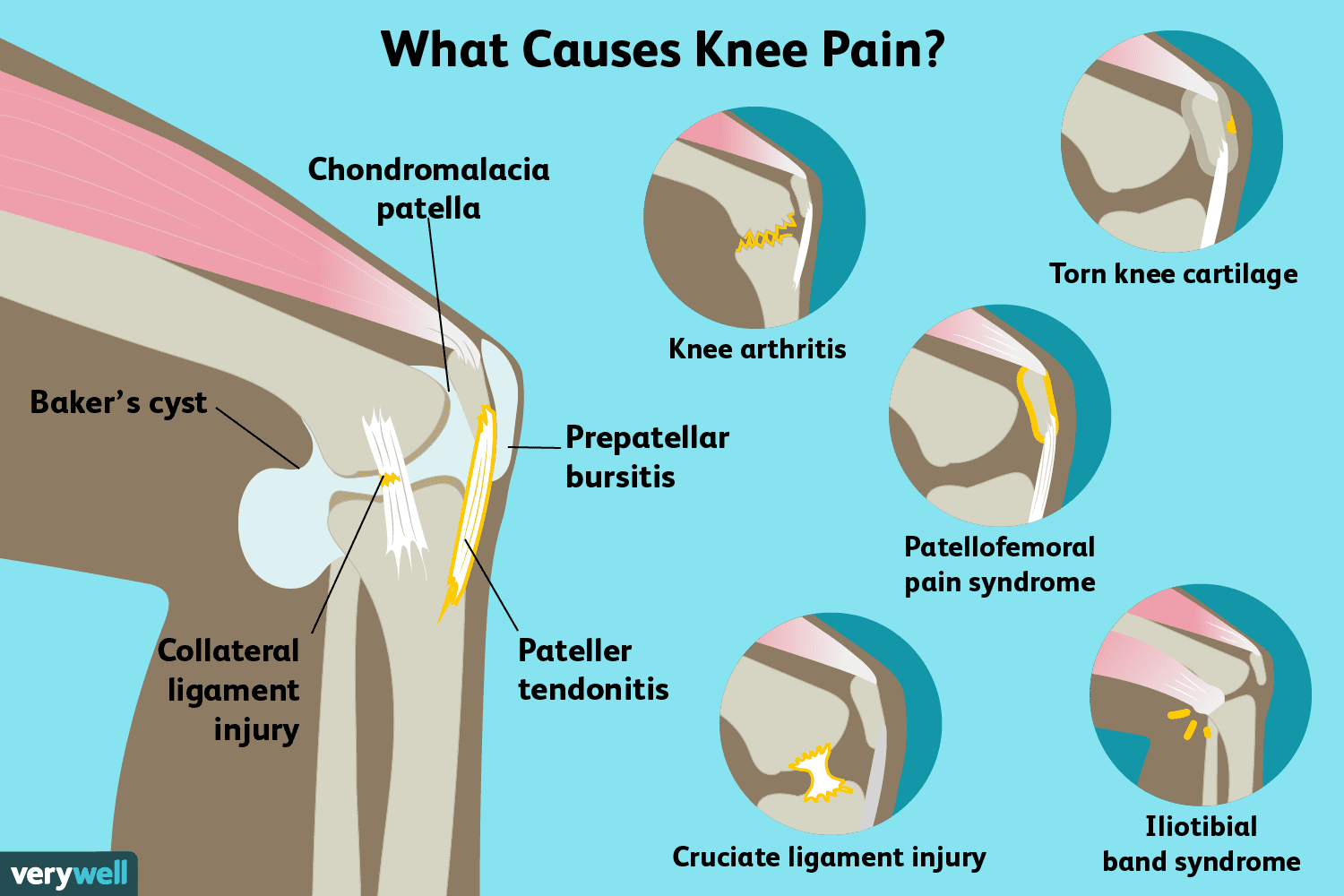 Knee Pain: Causes, Treatment, and When to See a Doctor