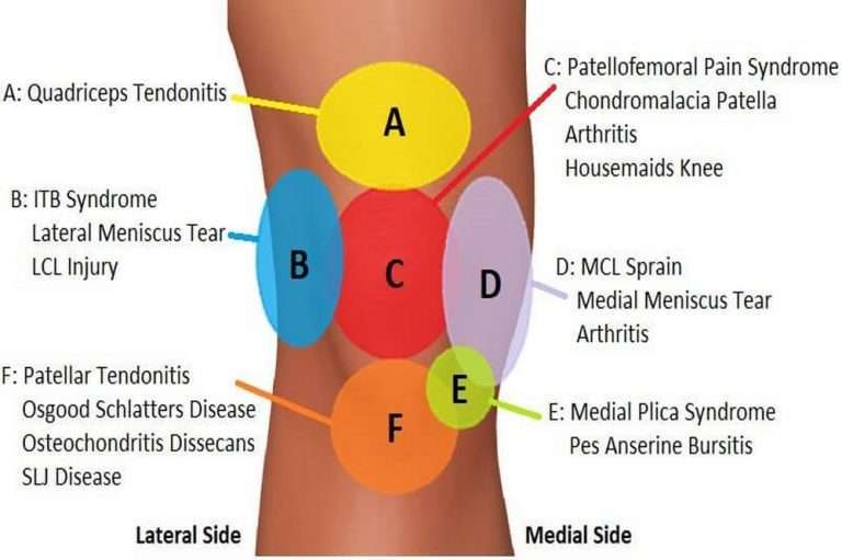 Knee Pain Diagnosis Chart