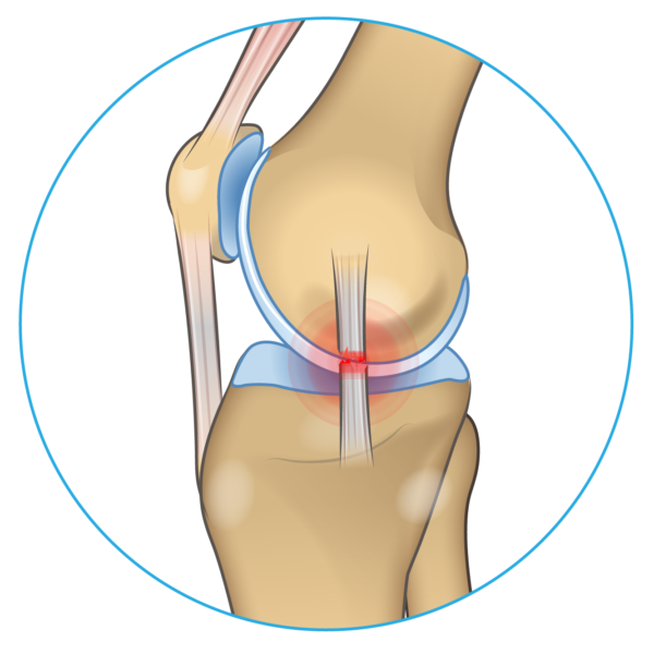 Knee Pain on the Inside of Your Joint? Causes &  Solutions ...