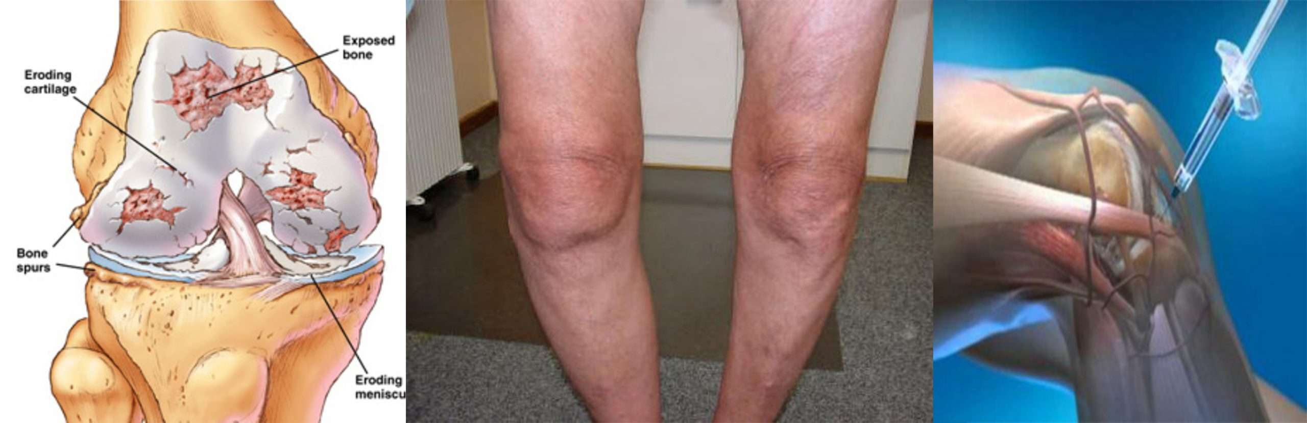 knee pain treatment Archives