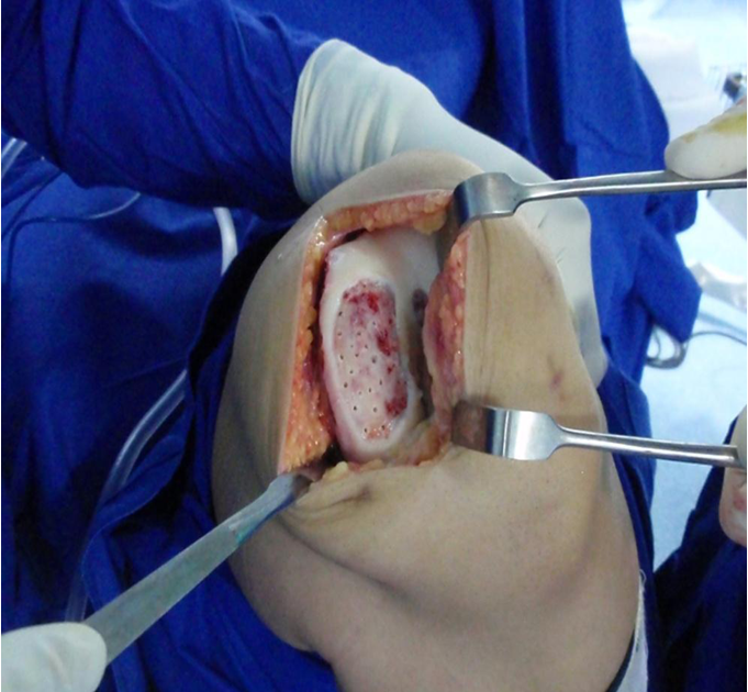 Knee Replacement and Sports Surgery: Knee pain