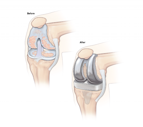 Knee Replacement Cost in India