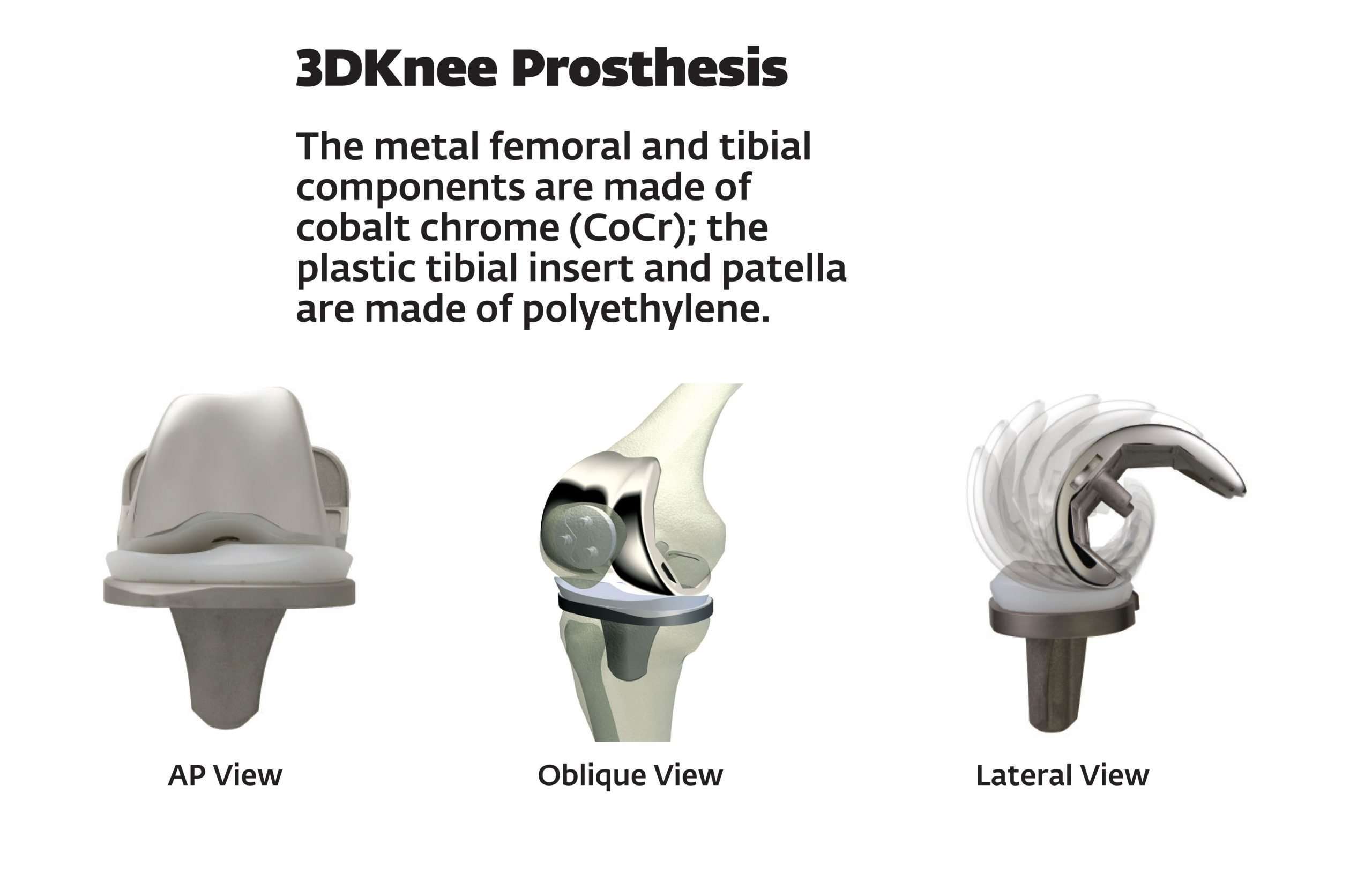Knee Replacement Implant Materials