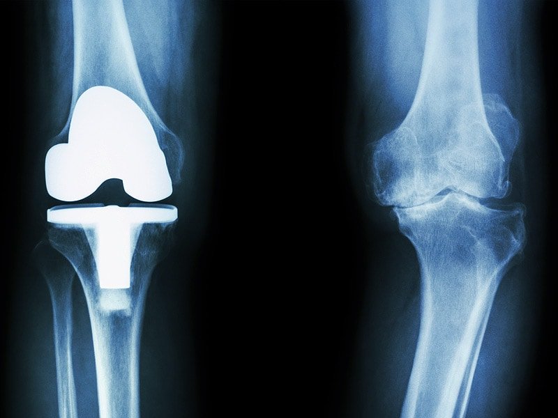 Knee Replacement Improves Pain, Ups Complications in RCT