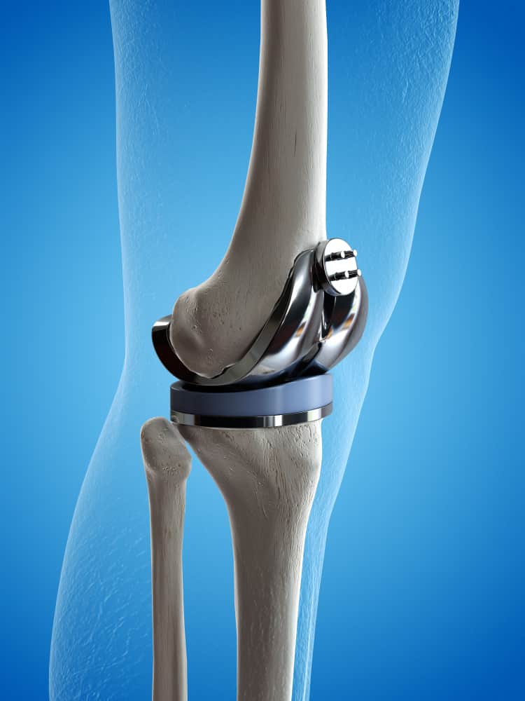 Knee Replacement Lawsuit
