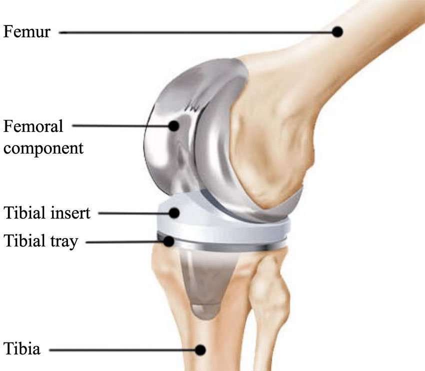 Knee Replacement Lawsuits