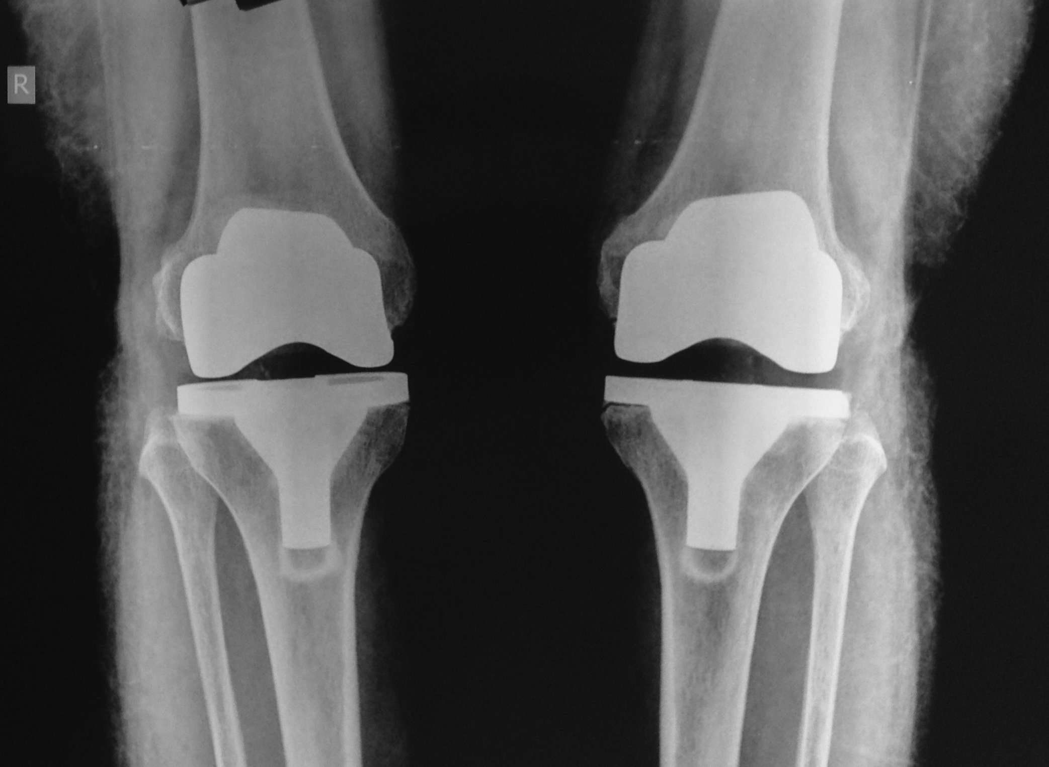 Knee Replacement  Nebraska Orthopaedic and Sports Medicine