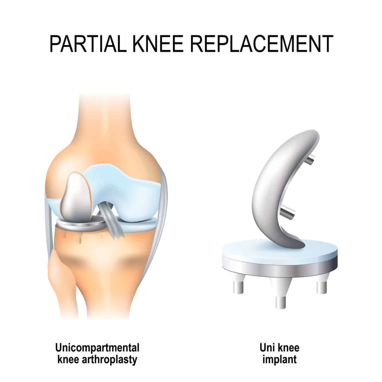 Knee Replacement Options