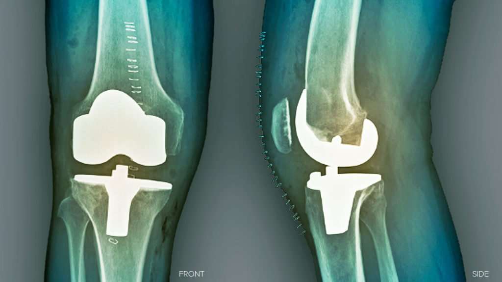 Knee replacement pain: Management and when to see a doctor