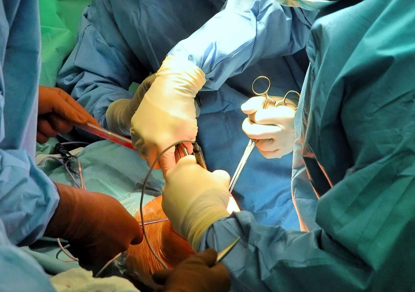 Knee Replacement Surgery for Knee Arthritis