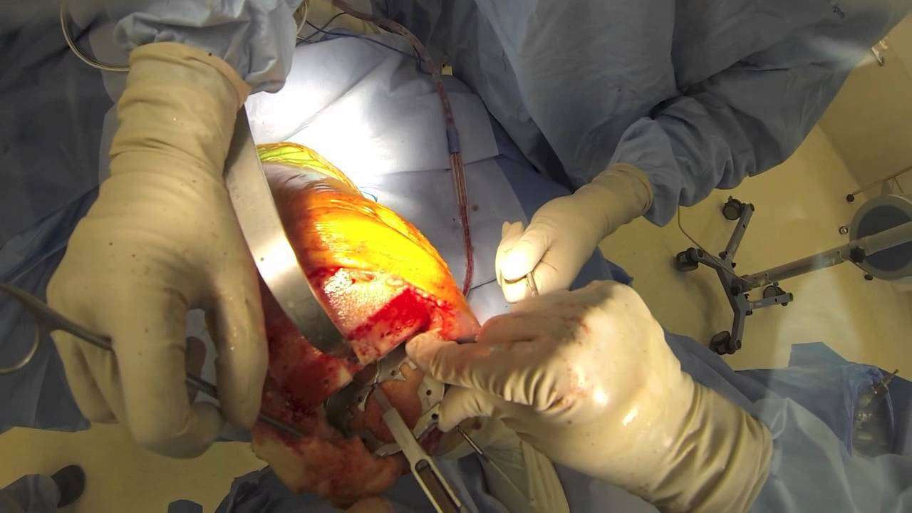 Knee replacement surgery (graphic)