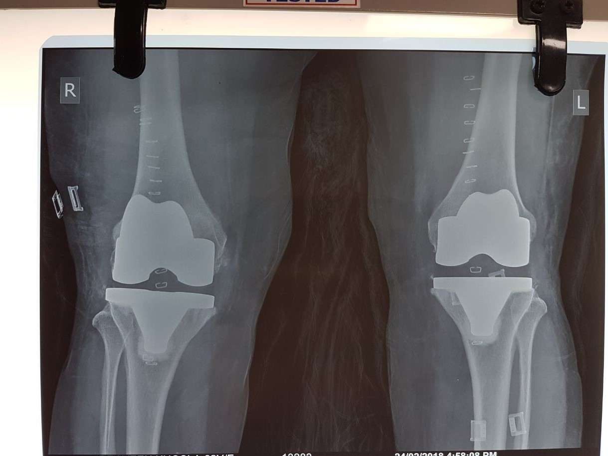 Knee Replacement Surgery Noida, NCR