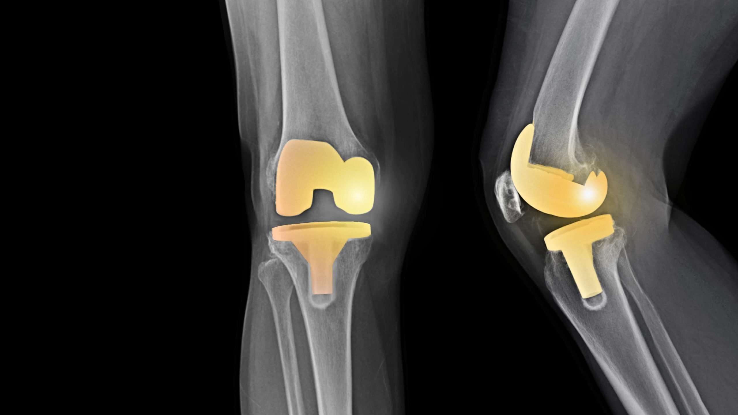 Knee Replacement Surgery: Overview