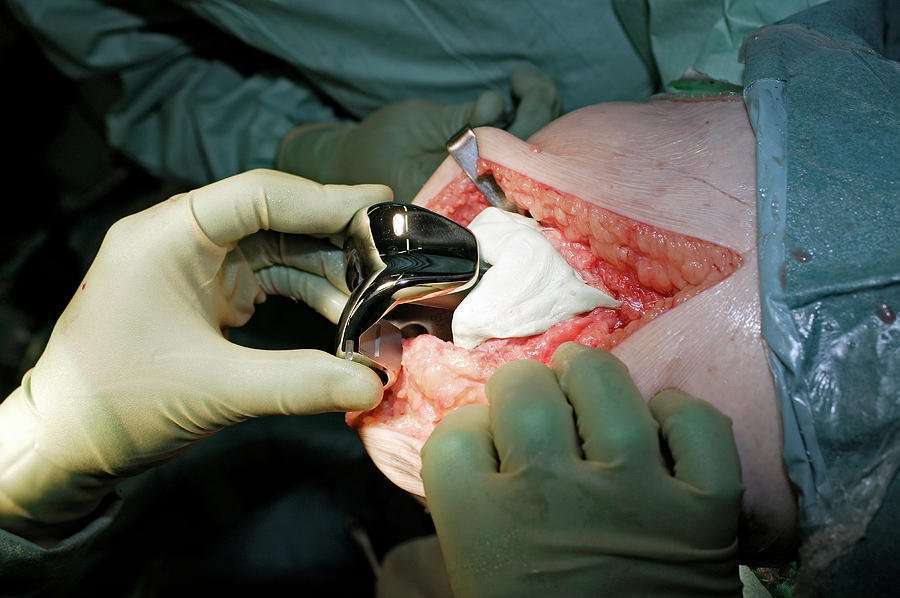Knee Replacement Surgery Photograph by Antonia Reeve ...