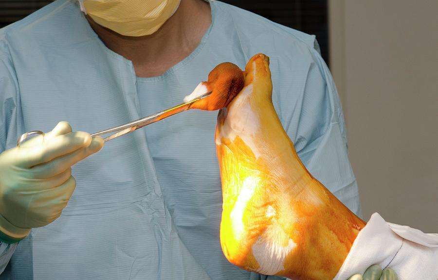 Knee Replacement Surgery Photograph by Dr P. Marazzi ...