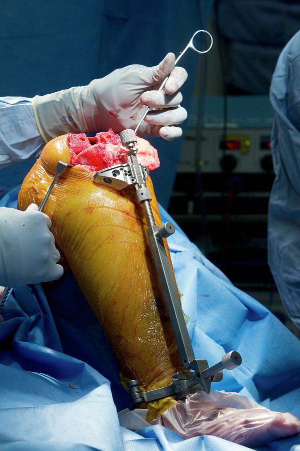 Knee Replacement Surgery Photograph by Mark Thomas/science ...